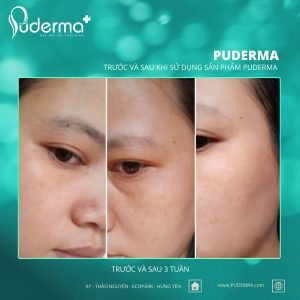 Nước tẩy trang Puderma Skin Balancing Control Cleansing Water